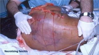 29
Necrotizing fasciitis
 
