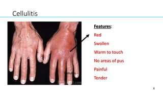 5
Cellulitis
Features:
Red
Swollen
Warm to touch
No areas of pus
Painful
Tender
Cellulitis
 