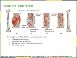 SLIDE 4.18 – BONE REPAIR
• The healing of a bone fracture follows a series of progressive steps:
a) A fracture hematoma forms.
b) Internal and external calli form.
c) Cartilage of the calli is replaced by trabecular bone.
d) Remodeling occurs.
Image source: Anatomy & Physiology, OpenStax College, © Rice University under a CC-BY 4.0 International license; adapted by MJJ.
 