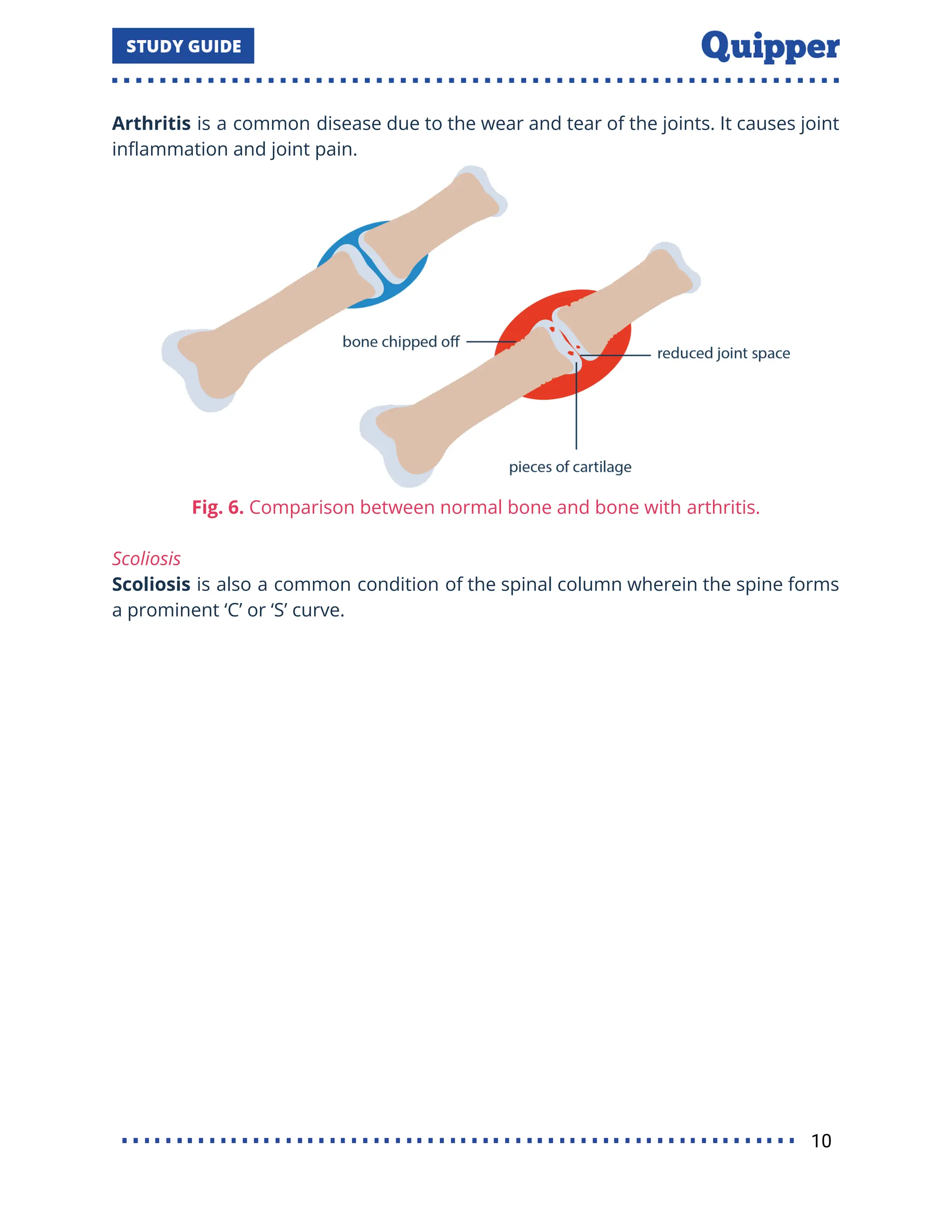 Arthritis is a common disease due to the wear and tear of the joints. It causes joint
inﬂammation and joint pain.
Fig. 6. Comparison between normal bone and bone with arthritis.
Scoliosis
Scoliosis is also a common condition of the spinal column wherein the spine forms
a prominent ‘C’ or ‘S’ curve.
10
 