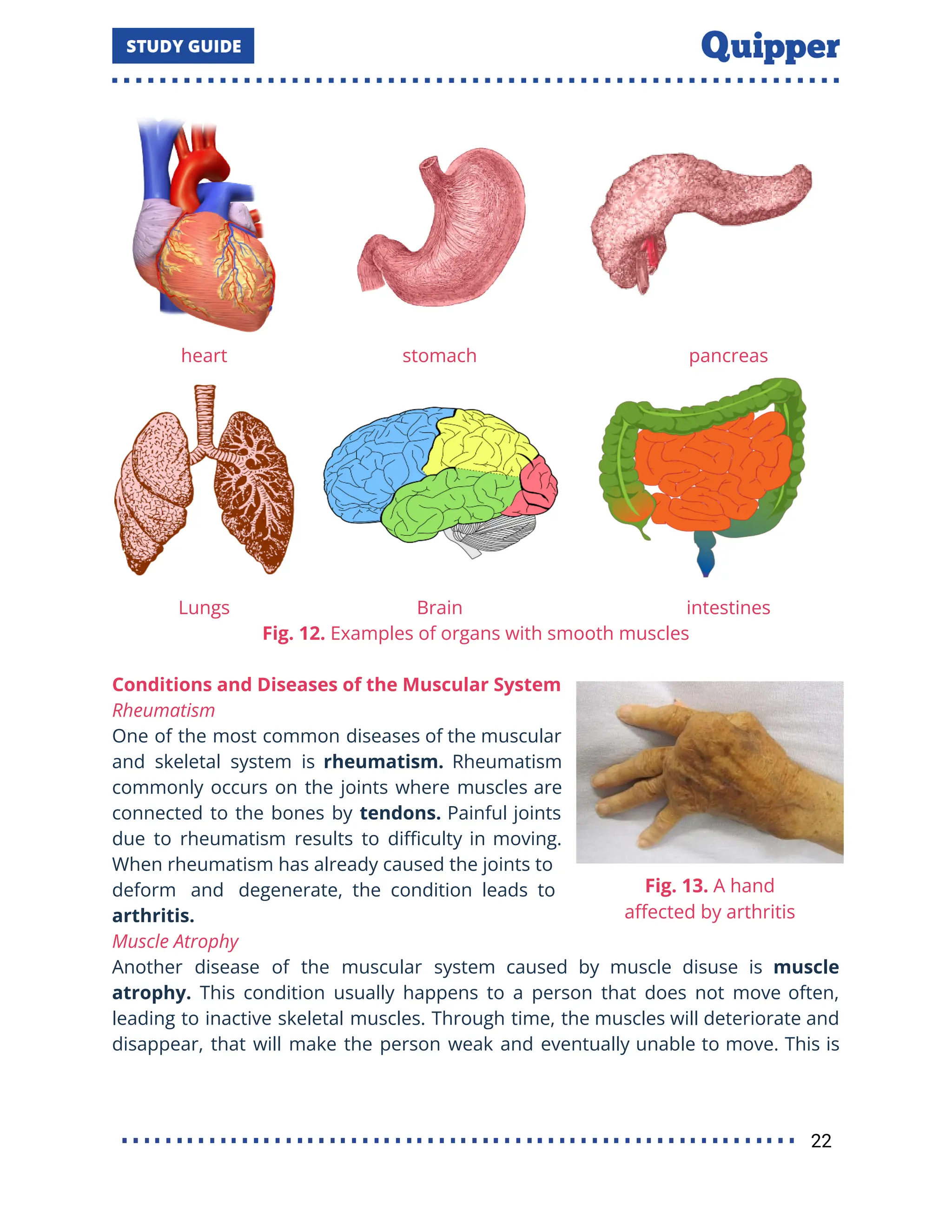 heart stomach pancreas
Lungs Brain intestines
Fig. 12. Examples of organs with smooth muscles
Conditions and Diseases of the Muscular System
Rheumatism
One of the most common diseases of the muscular
and skeletal system is rheumatism. Rheumatism
commonly occurs on the joints where muscles are
connected to the bones by tendons. Painful joints
due to rheumatism results to diﬃculty in moving.
When rheumatism has already caused the joints to
deform and degenerate, the condition leads to
arthritis.
Muscle Atrophy
Another disease of the muscular system caused by muscle disuse is muscle
atrophy. This condition usually happens to a person that does not move often,
leading to inactive skeletal muscles. Through time, the muscles will deteriorate and
disappear, that will make the person weak and eventually unable to move. This is
22
 