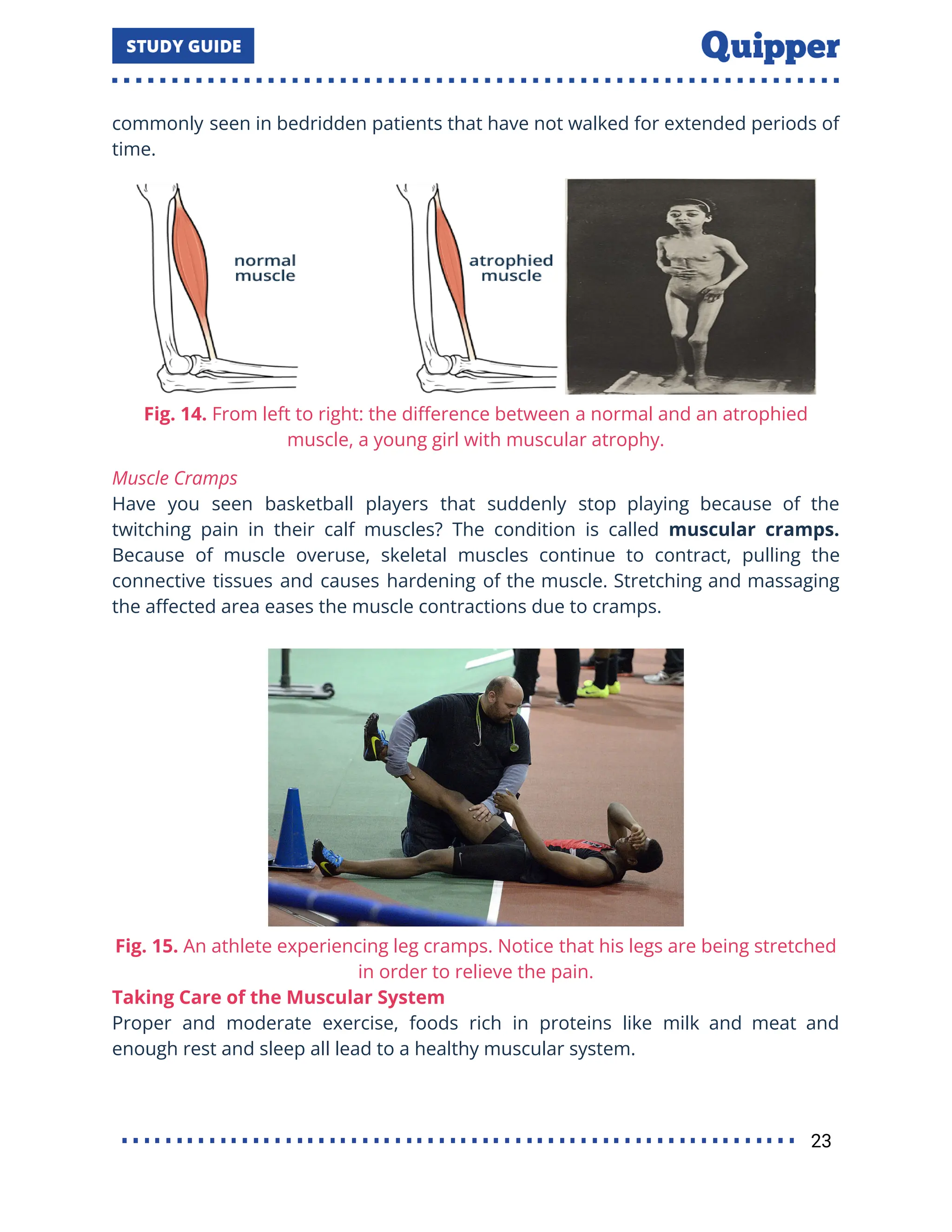 commonly seen in bedridden patients that have not walked for extended periods of
time.
Fig. 14. From left to right: the diﬀerence between a normal and an atrophied
muscle, a young girl with muscular atrophy.
Muscle Cramps
Have you seen basketball players that suddenly stop playing because of the
twitching pain in their calf muscles? The condition is called muscular cramps.
Because of muscle overuse, skeletal muscles continue to contract, pulling the
connective tissues and causes hardening of the muscle. Stretching and massaging
the aﬀected area eases the muscle contractions due to cramps.
Fig. 15. An athlete experiencing leg cramps. Notice that his legs are being stretched
in order to relieve the pain.
Taking Care of the Muscular System
Proper and moderate exercise, foods rich in proteins like milk and meat and
enough rest and sleep all lead to a healthy muscular system.
23
 