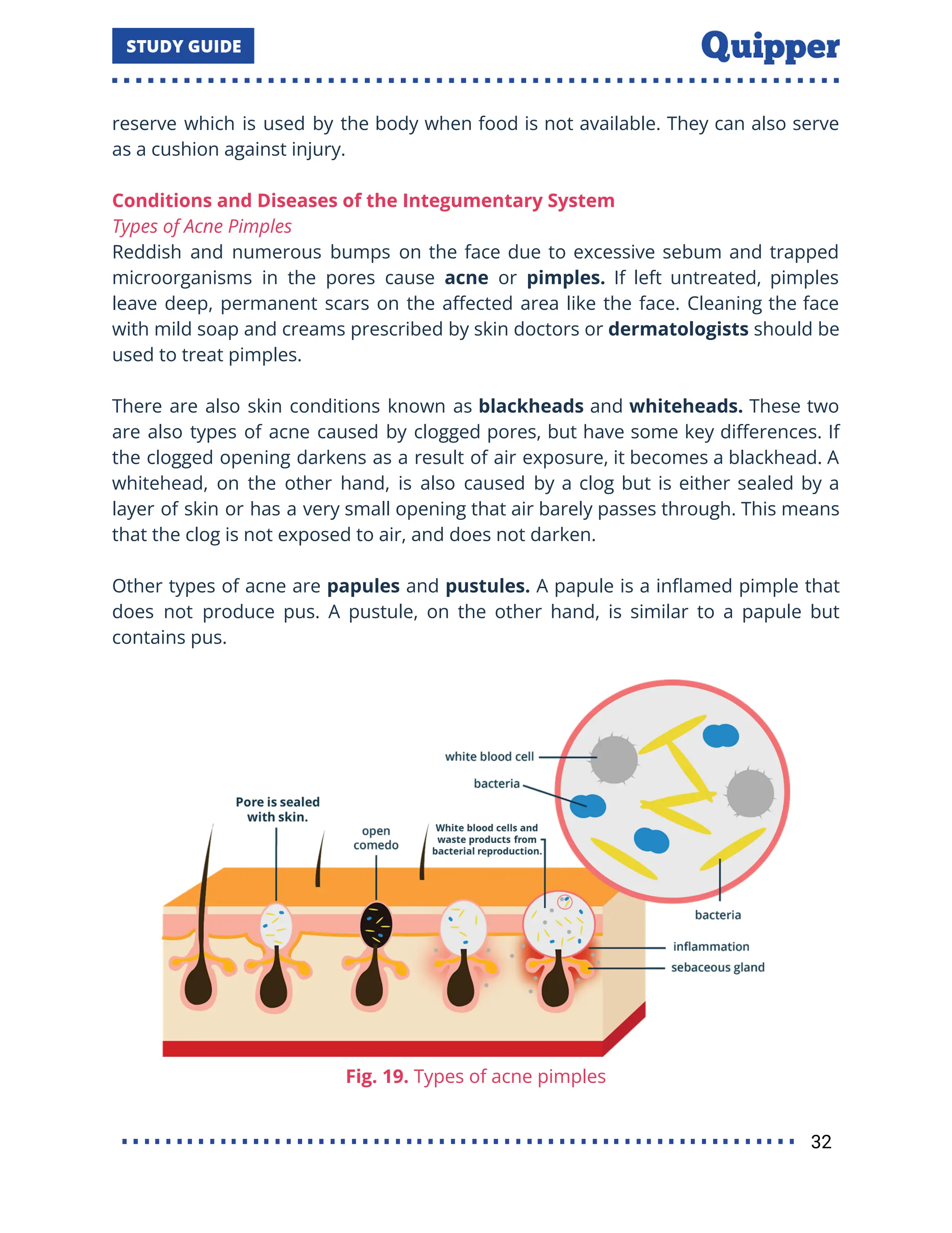 reserve which is used by the body when food is not available. They can also serve
as a cushion against injury.
Conditions and Diseases of the Integumentary System
Types of Acne Pimples
Reddish and numerous bumps on the face due to excessive sebum and trapped
microorganisms in the pores cause acne or pimples. If left untreated, pimples
leave deep, permanent scars on the aﬀected area like the face. Cleaning the face
with mild soap and creams prescribed by skin doctors or dermatologists should be
used to treat pimples.
There are also skin conditions known as blackheads and whiteheads. These two
are also types of acne caused by clogged pores, but have some key diﬀerences. If
the clogged opening darkens as a result of air exposure, it becomes a blackhead. A
whitehead, on the other hand, is also caused by a clog but is either sealed by a
layer of skin or has a very small opening that air barely passes through. This means
that the clog is not exposed to air, and does not darken.
Other types of acne are papules and pustules. A papule is a inﬂamed pimple that
does not produce pus. A pustule, on the other hand, is similar to a papule but
contains pus.
Fig. 19. Types of acne pimples
32
 