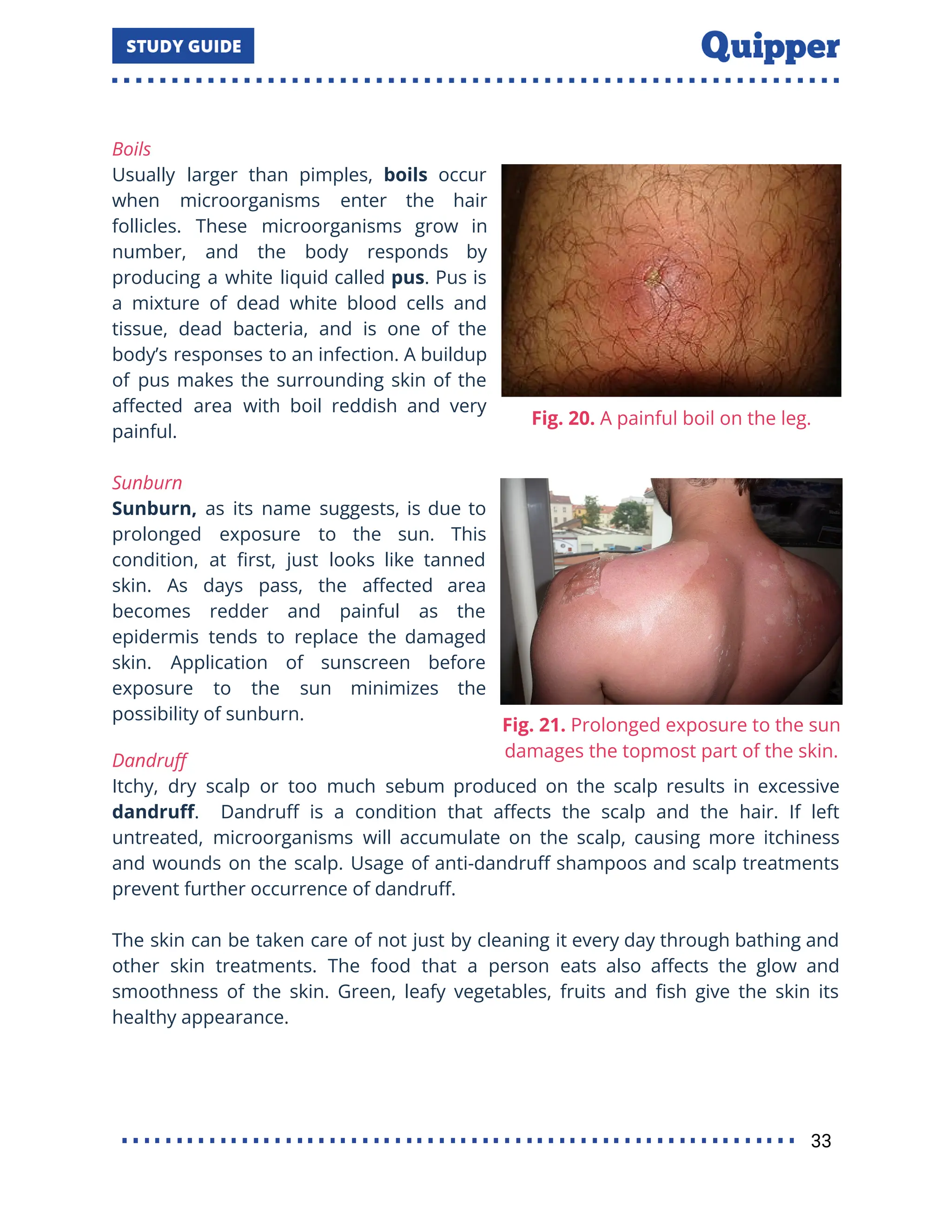 Boils
Usually larger than pimples, boils occur
when microorganisms enter the hair
follicles. These microorganisms grow in
number, and the body responds by
producing a white liquid called pus. Pus is
a mixture of dead white blood cells and
tissue, dead bacteria, and is one of the
body’s responses to an infection. A buildup
of pus makes the surrounding skin of the
aﬀected area with boil reddish and very
painful.
Sunburn
Sunburn, as its name suggests, is due to
prolonged exposure to the sun. This
condition, at ﬁrst, just looks like tanned
skin. As days pass, the aﬀected area
becomes redder and painful as the
epidermis tends to replace the damaged
skin. Application of sunscreen before
exposure to the sun minimizes the
possibility of sunburn.
Dandruﬀ
Itchy, dry scalp or too much sebum produced on the scalp results in excessive
dandruﬀ. Dandruﬀ is a condition that aﬀects the scalp and the hair. If left
untreated, microorganisms will accumulate on the scalp, causing more itchiness
and wounds on the scalp. Usage of anti-dandruﬀ shampoos and scalp treatments
prevent further occurrence of dandruﬀ.
The skin can be taken care of not just by cleaning it every day through bathing and
other skin treatments. The food that a person eats also aﬀects the glow and
smoothness of the skin. Green, leafy vegetables, fruits and ﬁsh give the skin its
healthy appearance.
33
 