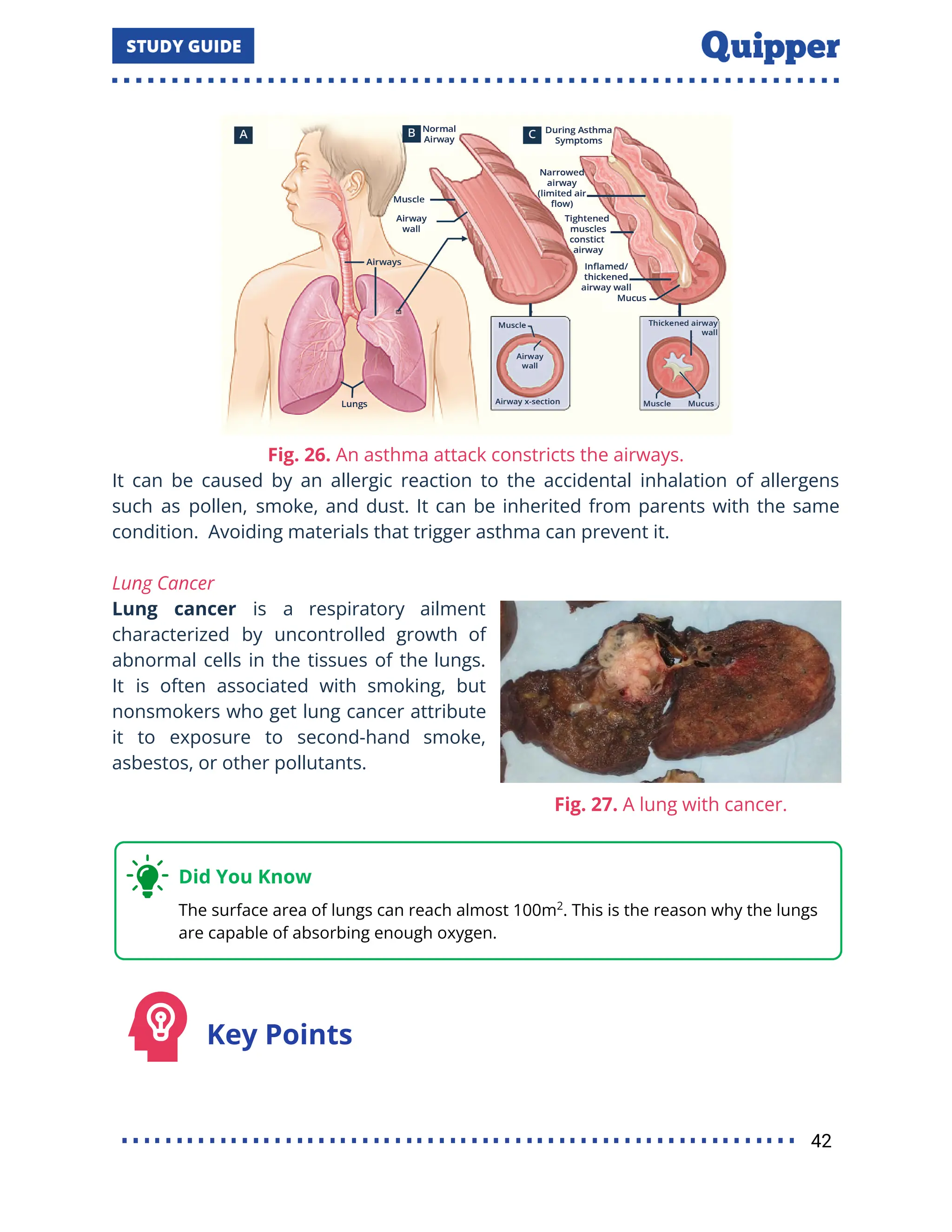 Fig. 26. An asthma attack constricts the airways.
It can be caused by an allergic reaction to the accidental inhalation of allergens
such as pollen, smoke, and dust. It can be inherited from parents with the same
condition. Avoiding materials that trigger asthma can prevent it.
Lung Cancer
Lung cancer is a respiratory ailment
characterized by uncontrolled growth of
abnormal cells in the tissues of the lungs.
It is often associated with smoking, but
nonsmokers who get lung cancer attribute
it to exposure to second-hand smoke,
asbestos, or other pollutants.
Key Points
42
 