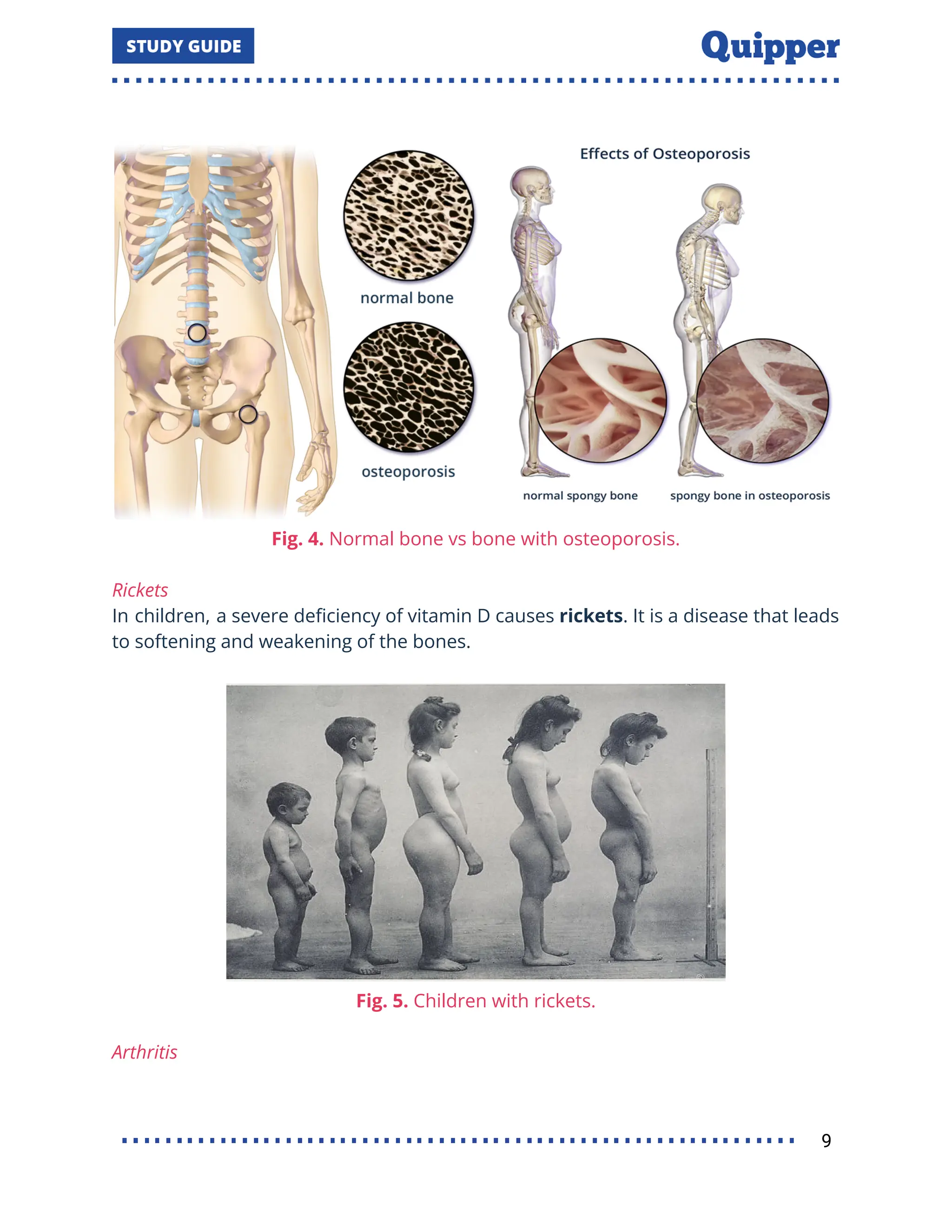 Fig. 4. Normal bone vs bone with osteoporosis.
Rickets
In children, a severe deﬁciency of vitamin D causes rickets. It is a disease that leads
to softening and weakening of the bones.
Fig. 5. Children with rickets.
Arthritis
9
 
