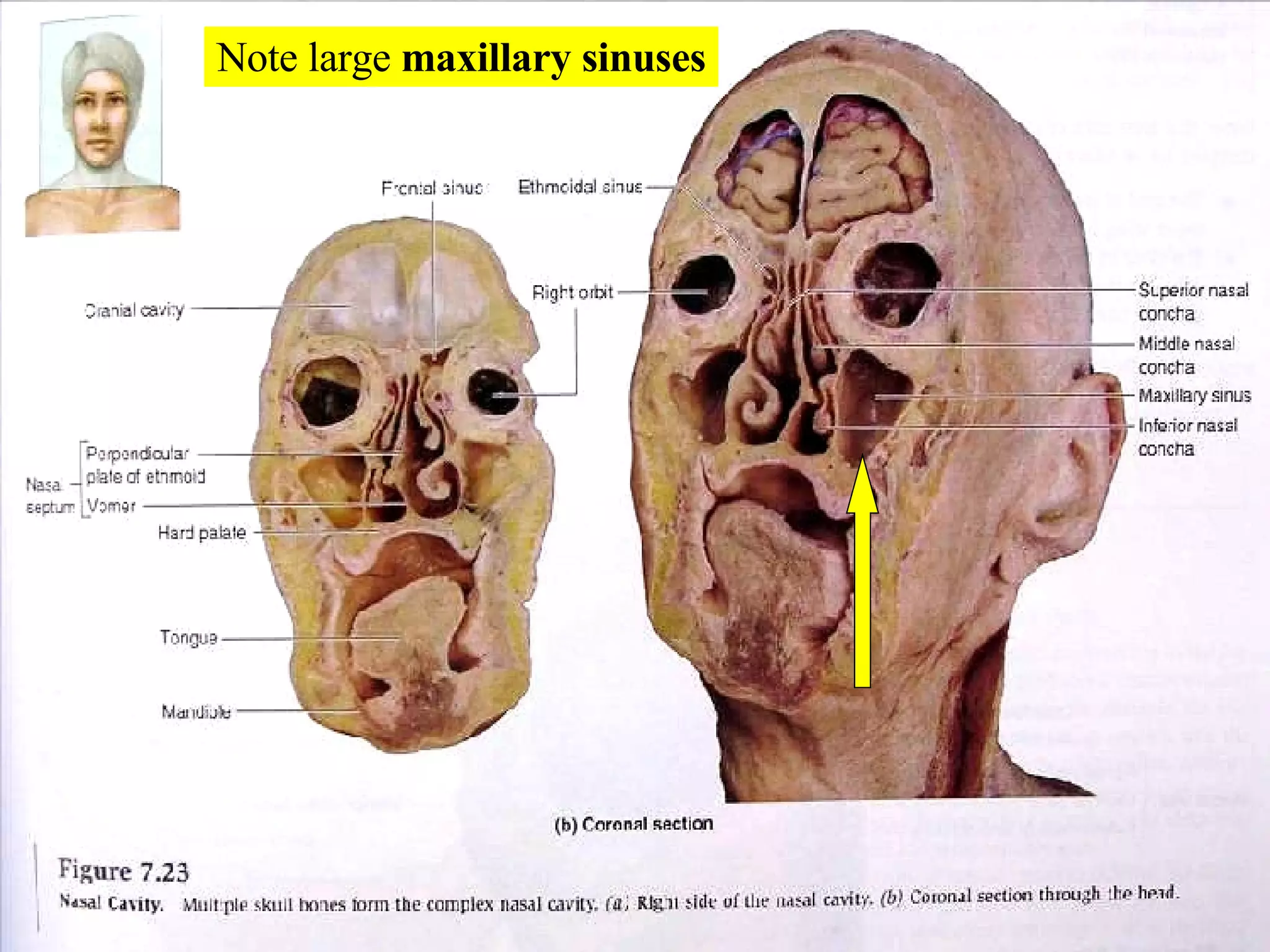 Note large  maxillary sinuses 