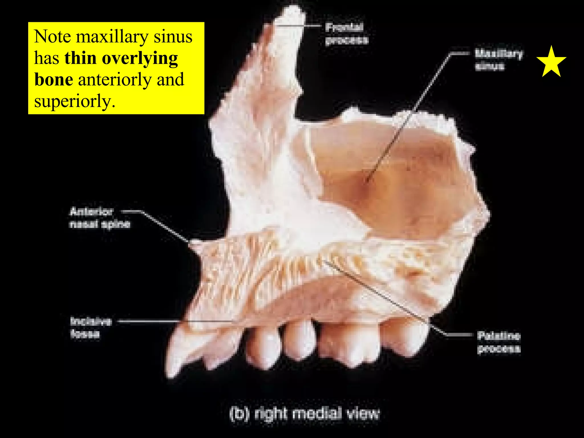 Note maxillary sinus has  thin overlying bone  anteriorly and superiorly. 