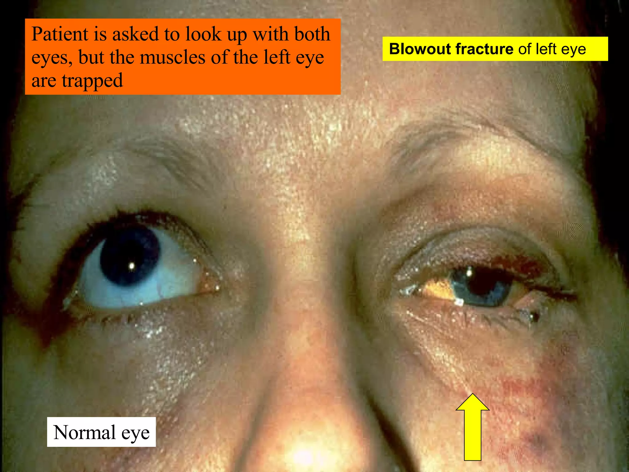 Blowout fracture  of left eye Patient is asked to look up with both eyes, but the muscles of the left eye are trapped Normal eye 