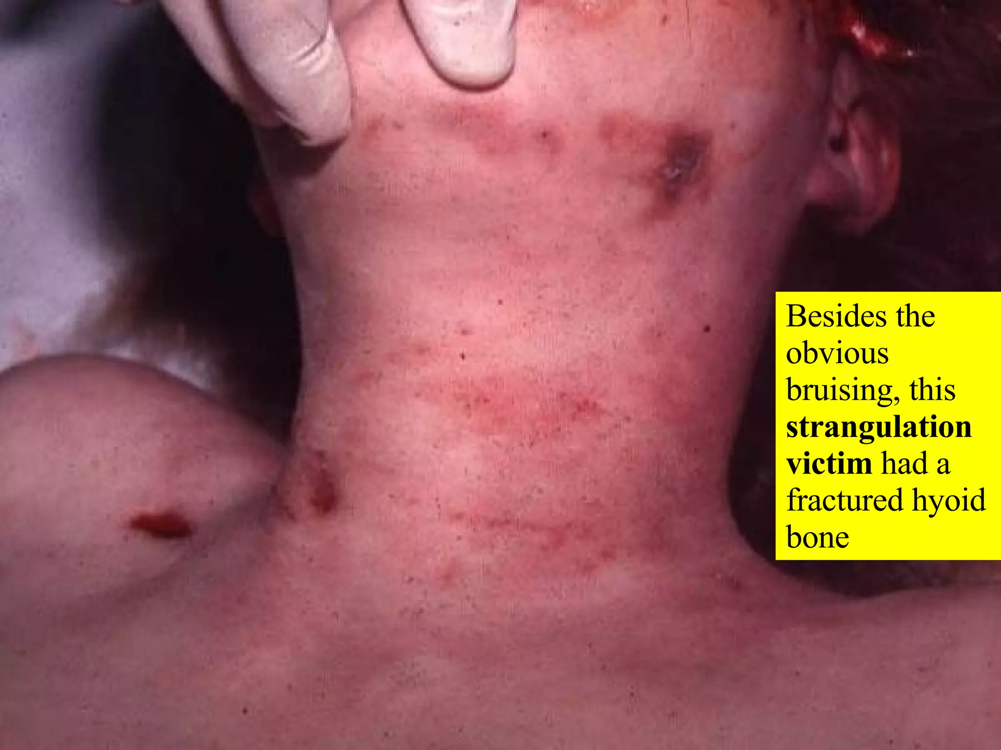 Besides the  obvious bruising, this  strangulation victim  had a fractured hyoid bone 