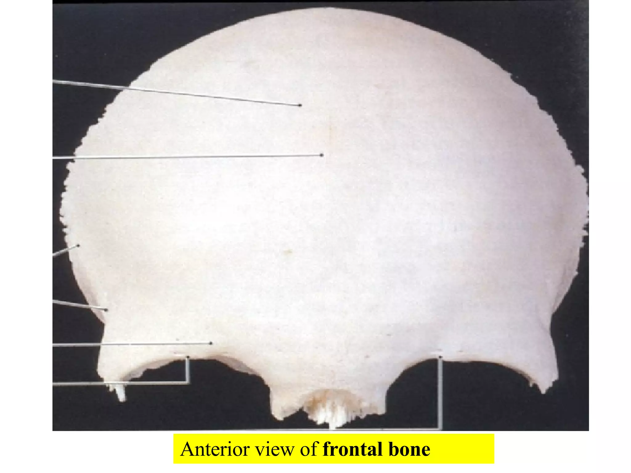 Anterior view of  frontal bone 