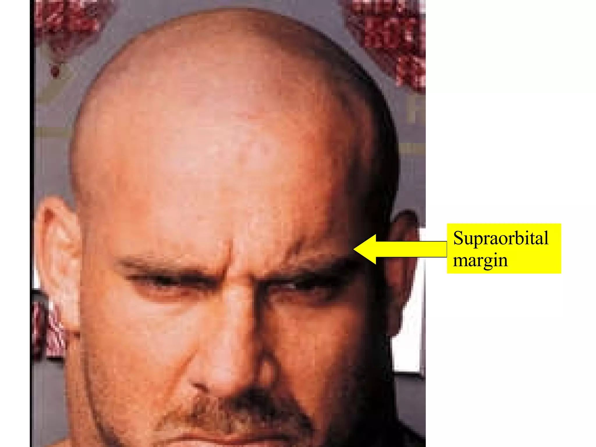 Supraorbital  margin 