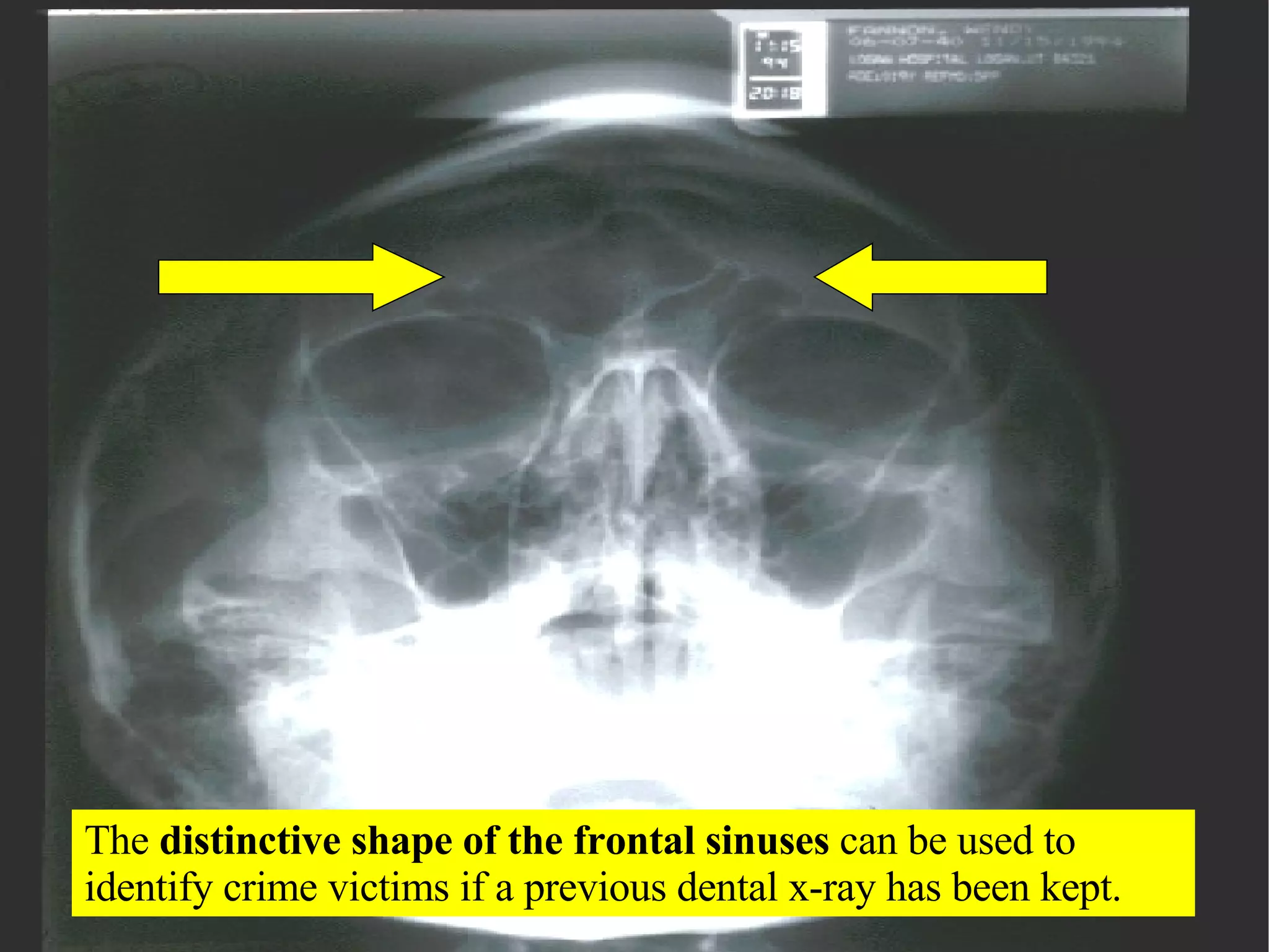 The  distinctive shape of the frontal sinuses  can be used to identify crime victims if a previous dental x-ray has been kept. 