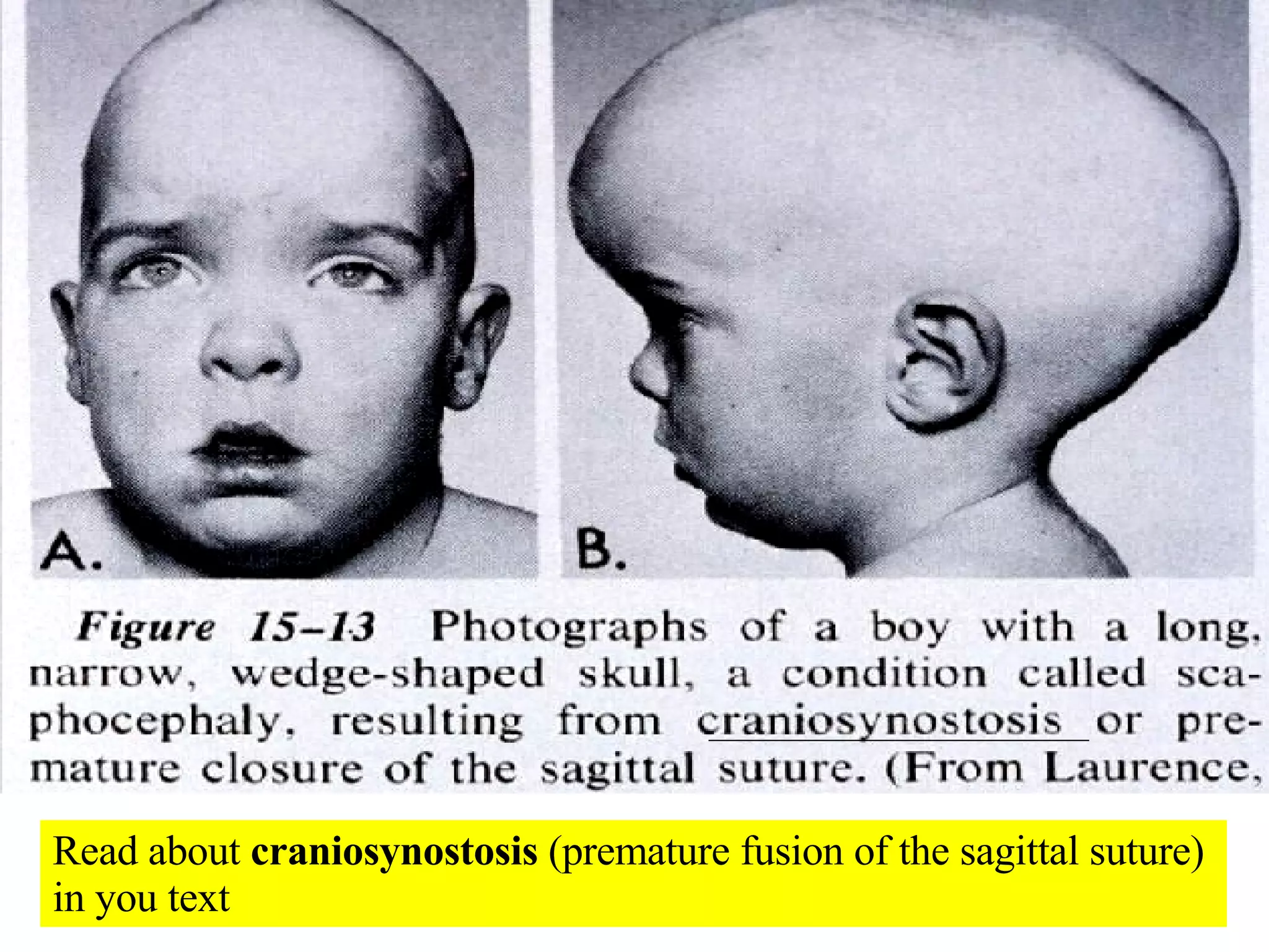 Read about  craniosynostosis  (premature fusion of the sagittal suture) in you text  