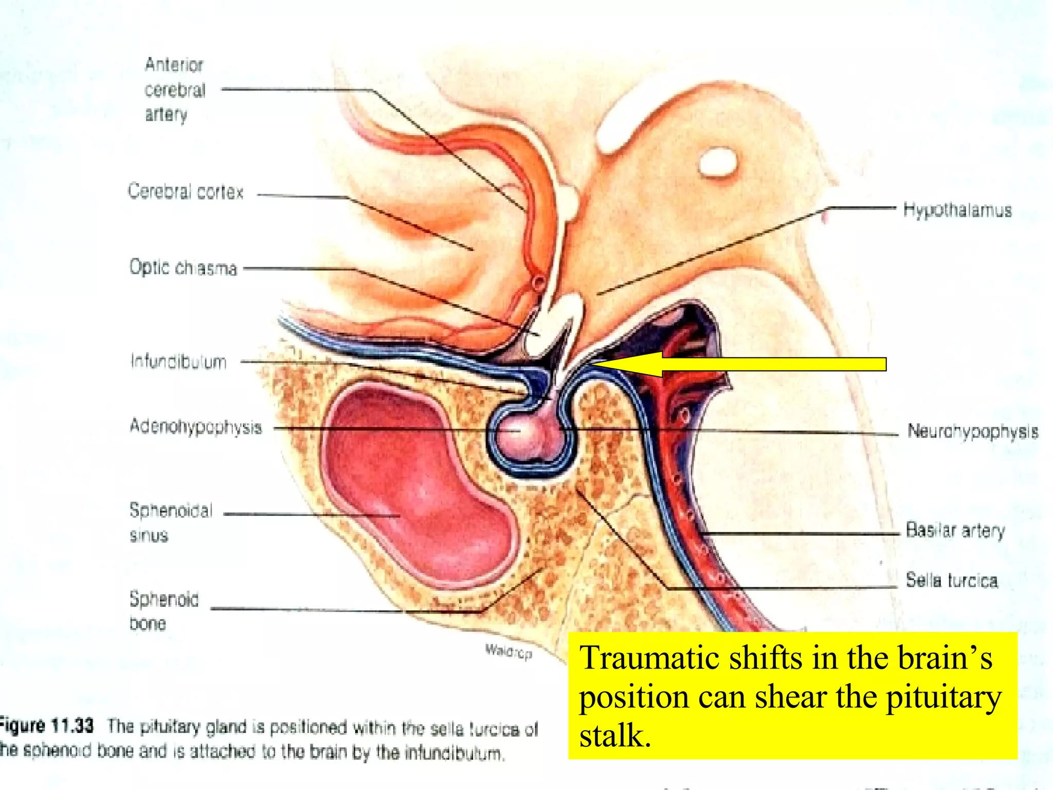 Traumatic shifts in the brain’s position can shear the pituitary stalk. 