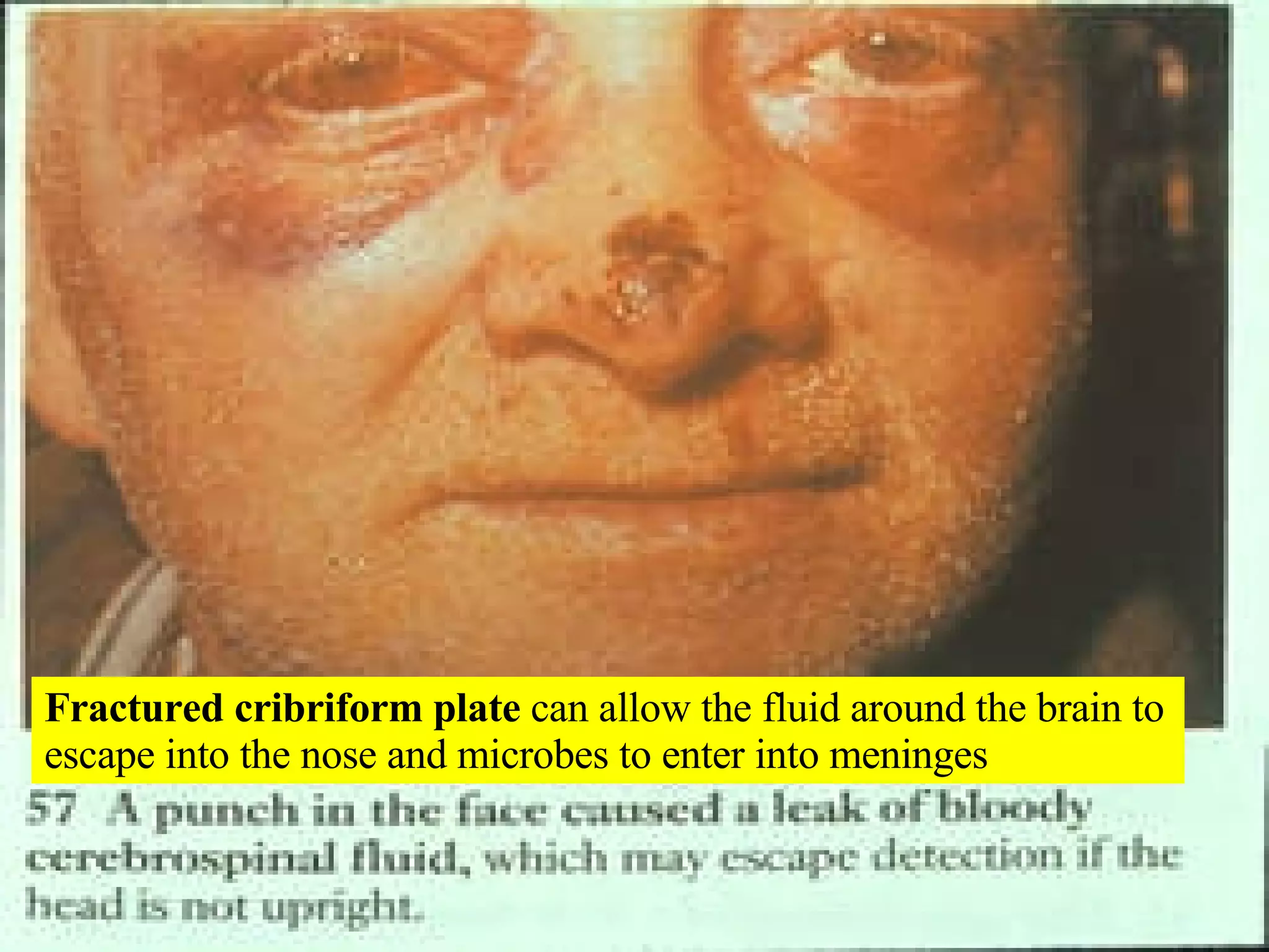 Fractured cribriform plate  can allow the fluid around the brain to escape into the nose and microbes to enter into meninges 