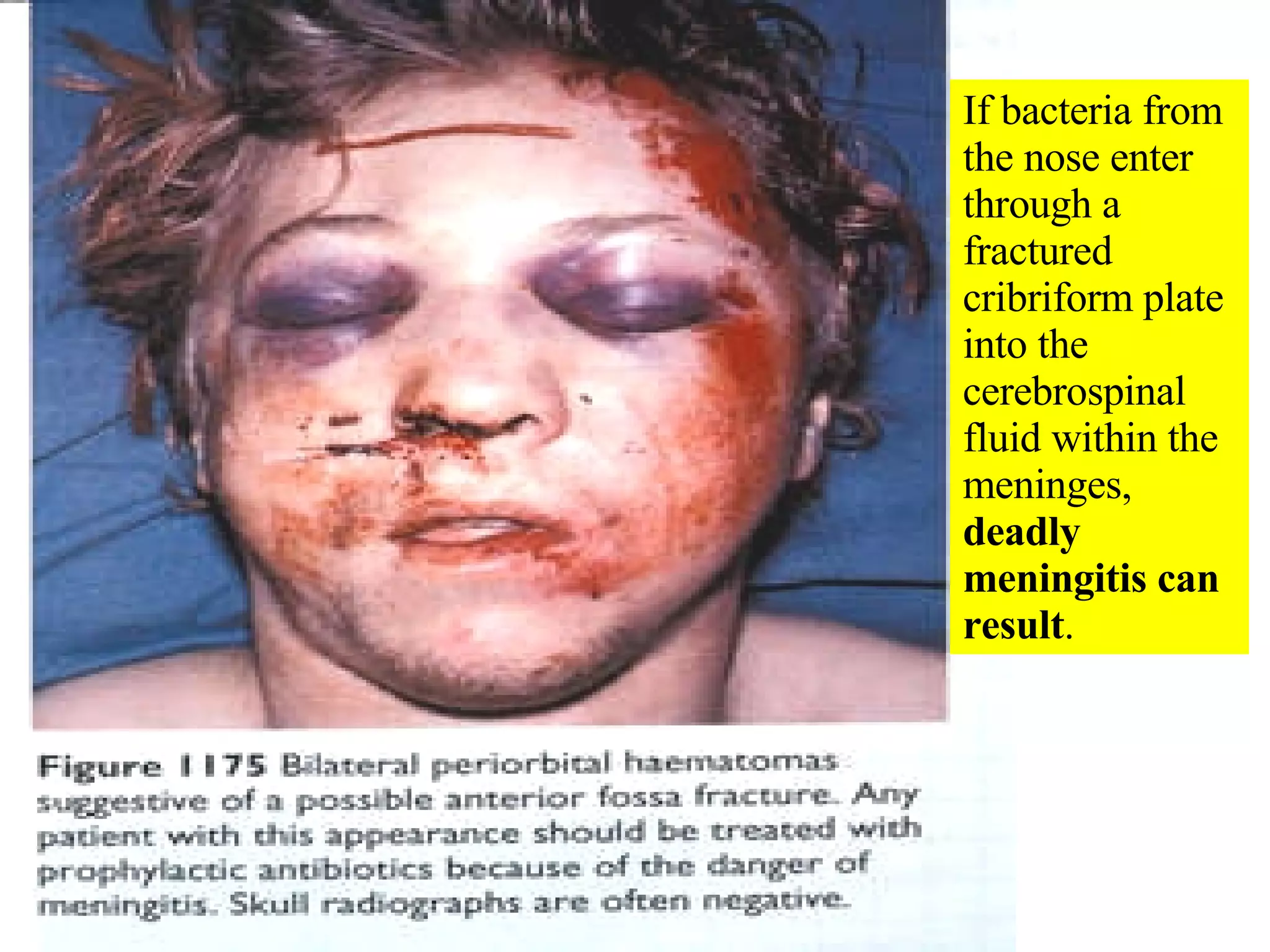 If bacteria from the nose enter through a fractured cribriform plate into the cerebrospinal fluid within the meninges,  deadly meningitis can result . 