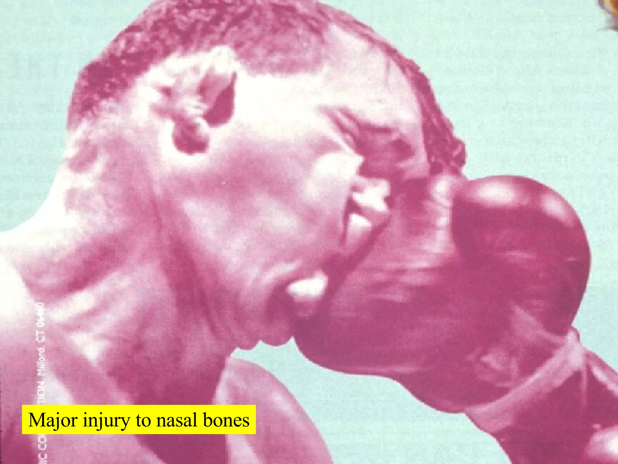 Major injury to nasal bones 