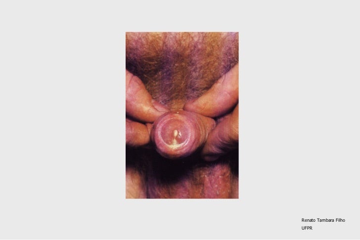 ureaplasma ?i tratamentul artritei ureaplasma ?i tratamentul artritei