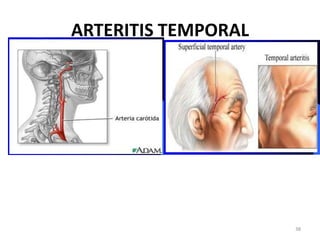 ARTERITIS TEMPORAL




                     38
 