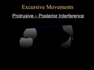 Proclusive Concepts of Complete denture occlusion | PPT