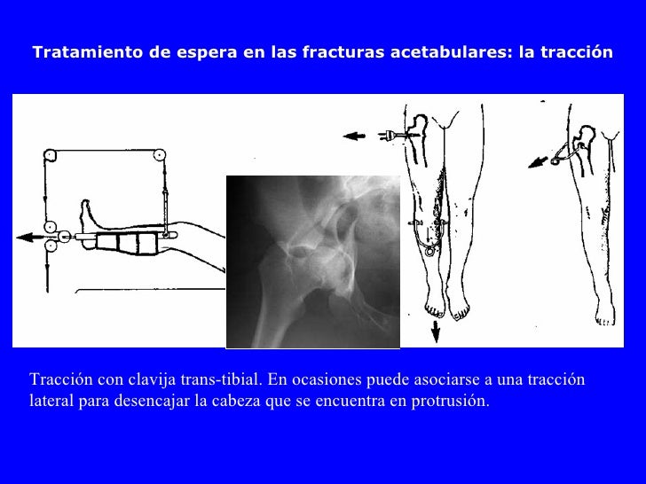 04 fracturasde_acetabulo