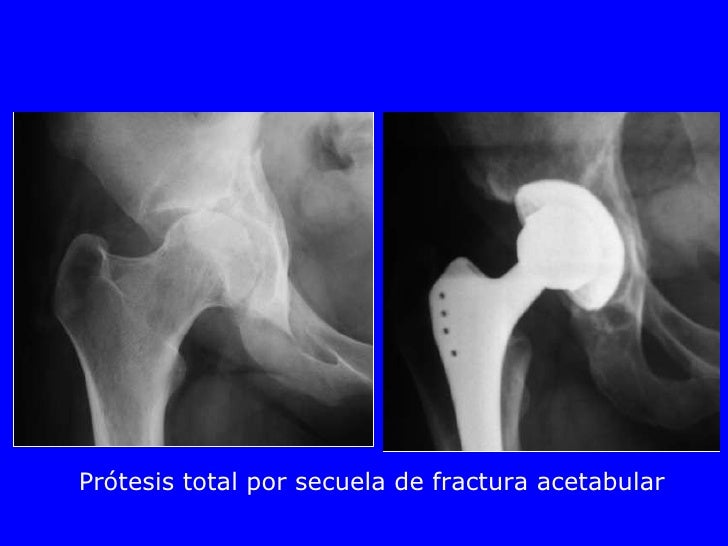 04 fracturasde_acetabulo