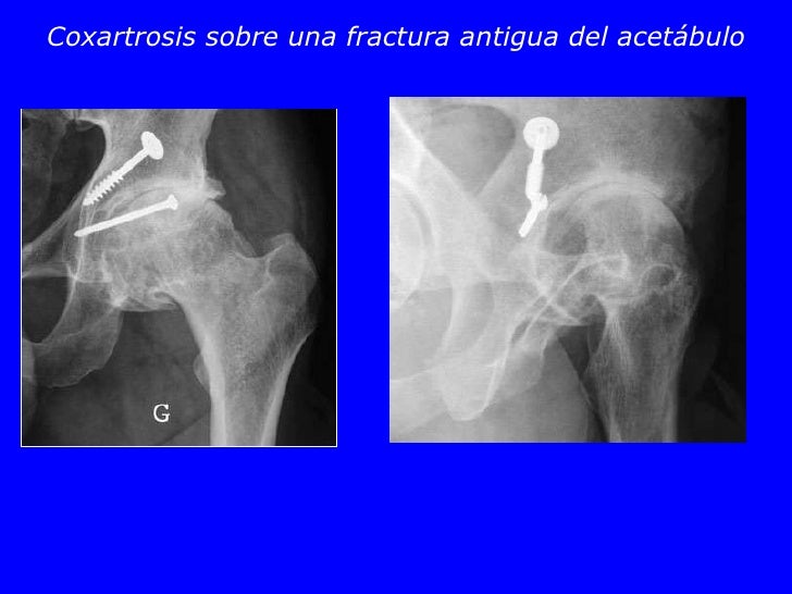 04 fracturasde_acetabulo