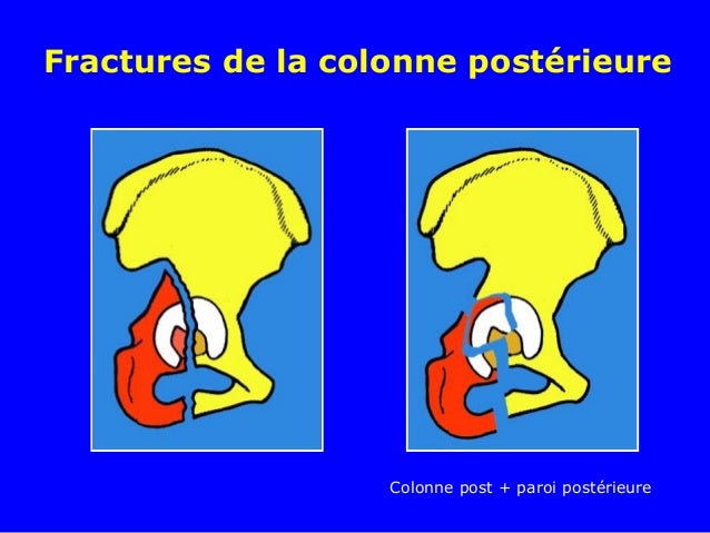 fracture-du-cotyle-cim-10-fracture-cotyle-hanche-cim-10-twlpp