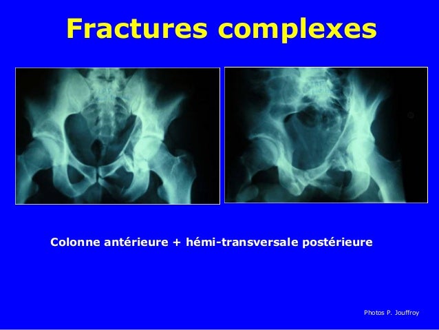 fracture-cotyle-definition-sp-cialiste-de-la-hanche-puvusc