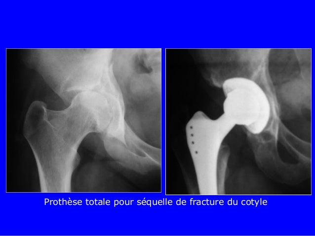 qu-est-ce-que-la-fracture-du-cotyle-nitb