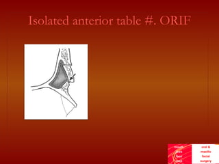 frontal sinus obliteration frontal sinus obliteration