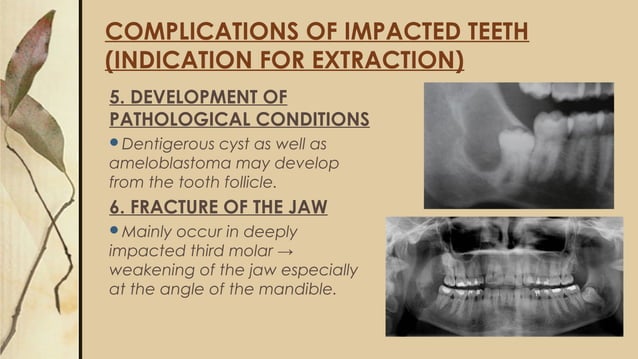 Surgical removal of Impacted teeth | PPT