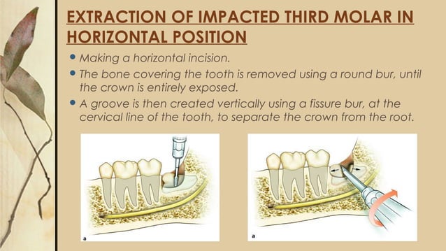 Surgical removal of Impacted teeth | PPT