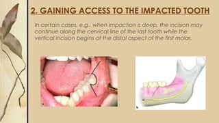 2. GAINING ACCESS TO THE IMPACTED TOOTH
In certain cases, e.g., when impaction is deep, the incision may
continue along the cervical line of the last tooth while the
vertical incision begins at the distal aspect of the first molar.
 