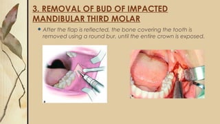 3. REMOVAL OF BUD OF IMPACTED
MANDIBULAR THIRD MOLAR
 After the flap is reflected, the bone covering the tooth is
removed using a round bur, until the entire crown is exposed.
 