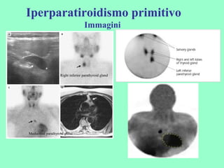 Iperparatiroidismo primitivo
Immagini
Right inferior parathyroid gland
Mediastnal parathyroid gland
 