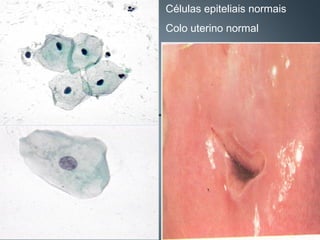Células epiteliais normais
Colo uterino normal
 
