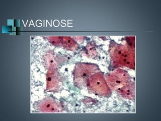 VAGINOSE
 