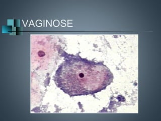 VAGINOSE
 
