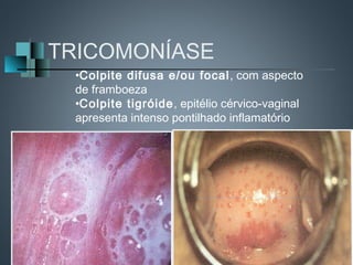 TRICOMONÍASE
 •Colpite difusa e/ou focal , com aspecto
 de framboeza
 •Colpite tigróide, epitélio cérvico-vaginal
 apresenta intenso pontilhado inflamatório
 