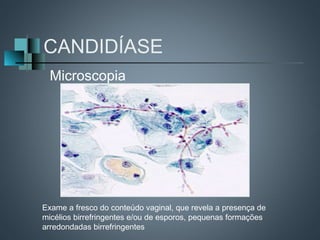 CANDIDÍASE
  Microscopia




Exame a fresco do conteúdo vaginal, que revela a presença de
micélios birrefringentes e/ou de esporos, pequenas formações
arredondadas birrefringentes
 
