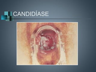 CANDIDÍASE
 