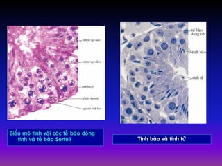 Bieåu moâ tinh vôùi caùc teá baøo doøng
tinh vaø teá baøo Sertoli Tinh baøo vaø tinh töû
 