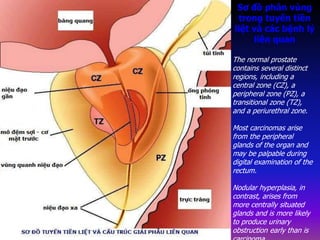 The normal prostate
contains several distinct
regions, including a
central zone (CZ), a
peripheral zone (PZ), a
transitional zone (TZ),
and a periurethral zone.
Most carcinomas arise
from the peripheral
glands of the organ and
may be palpable during
digital examination of the
rectum.
Nodular hyperplasia, in
contrast, arises from
more centrally situated
glands and is more likely
to produce urinary
obstruction early than is
Sơ đồ phân vùng
trong tuyến tiền
liệt và các bệnh lý
liên quan
 