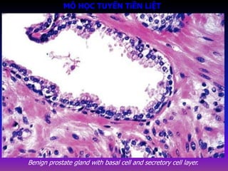 Benign prostate gland with basal cell and secretory cell layer.
MÔ HỌC TUYẾN TiỀN LiỆT
 