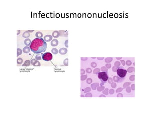 Infectiousmononucleosis
 