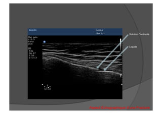 Solution Continuité
Liquide
Aspect Échographique d’une Fracture
 