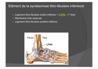 Elément de la syndesmose tibio-fibulaire inférieure
—  Ligament tibio-fibulaire antéro-inférieur = LTFAI , 1er lésé
—  Membrane inter-osseuse
—  Ligament tibio-fibulaire postéro-inférieur
Fibula Tibia
LTFAI
LTFA
 