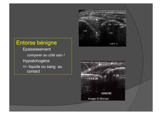 Entorse bénigne
Epaississement
comparer au côté sain !
Hypoéchogène
+/- liquide ou sang au
contact
Image G Morvan
 